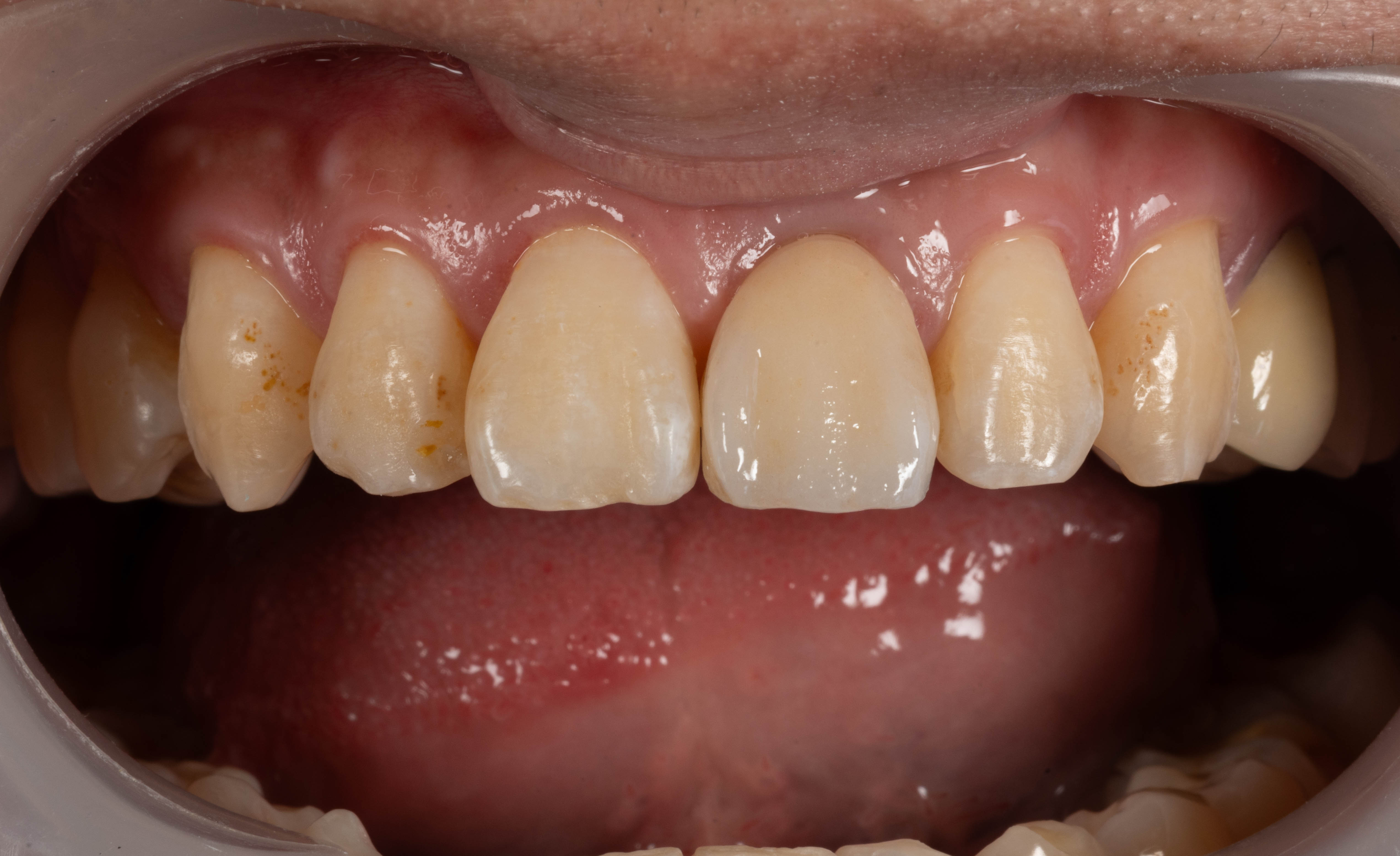 前牙區 全瓷冠假牙